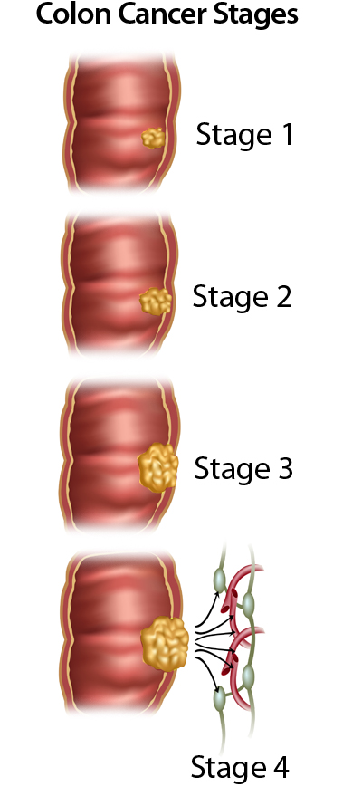 Colon cancer Information