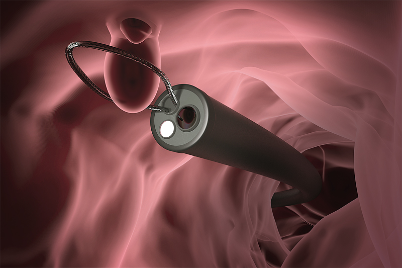 Colonoscopy and polypectomy