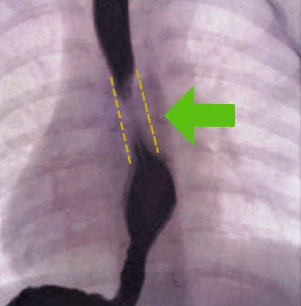 esophageal disease fluoroscopy