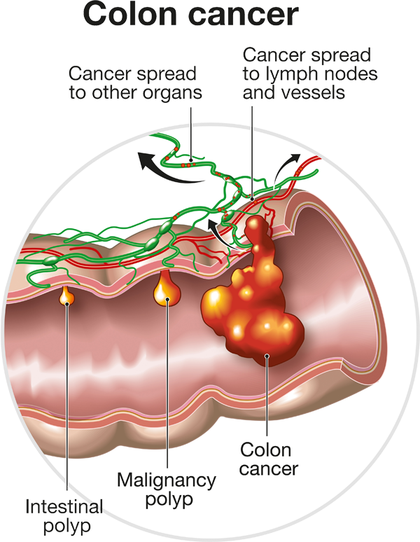 About Colorectal Cancer Symptoms, Risk Factors, Diagnosis & Stages