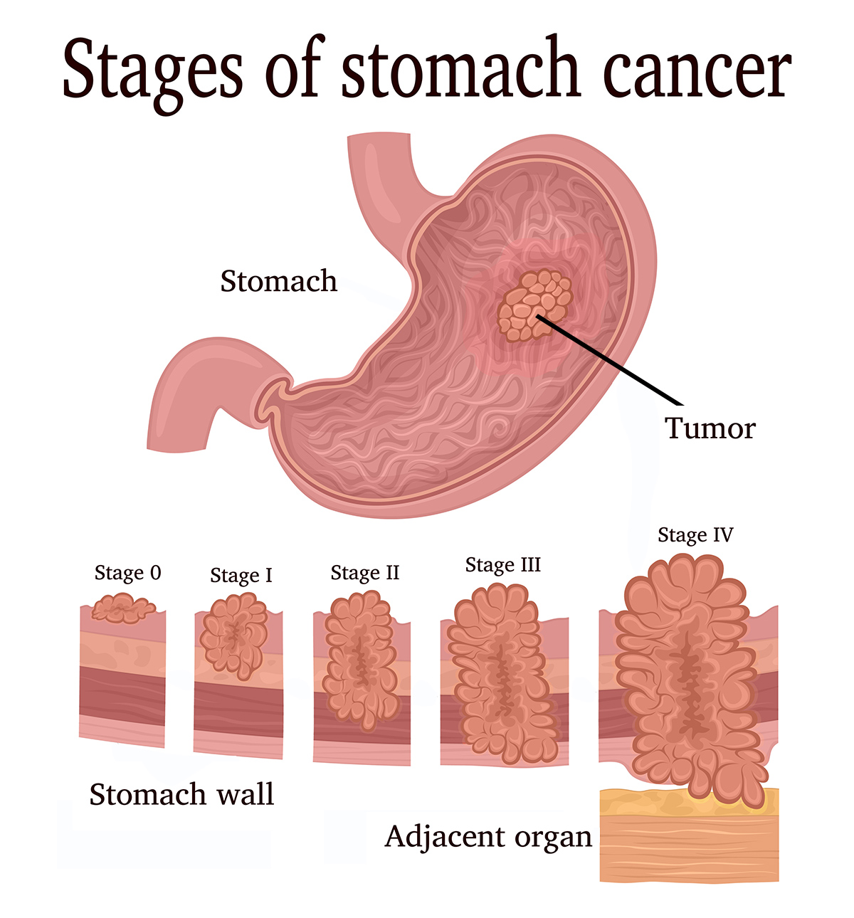 A diagram of the stages of stomach cancer