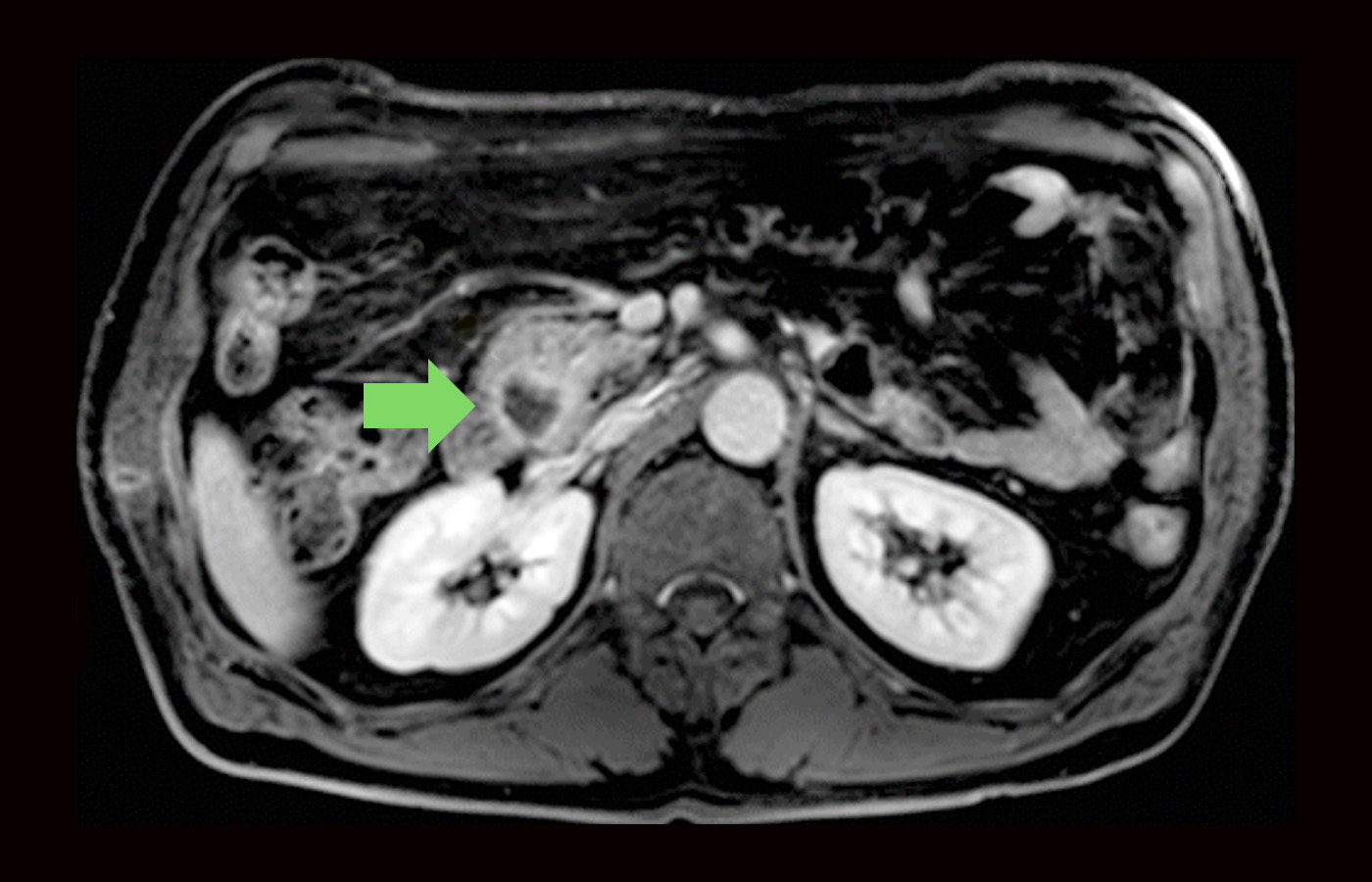 pancreatic-cancer-symptoms-diagnosis-and-treatment-saint-john-s