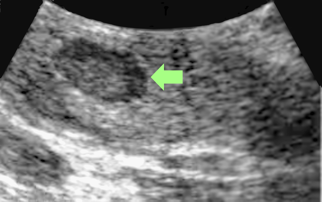 Gastrinoma on ultrasound