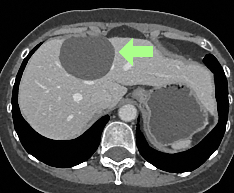 liver-cysts-saint-johns-cancer-institute