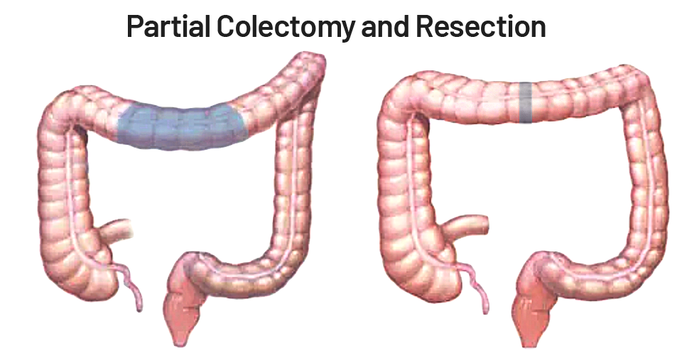 Partial colectomy and resection of the colon - saint johns cancer institute