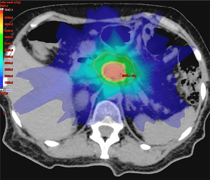 External beam radiation therapy for pancreatic cancer