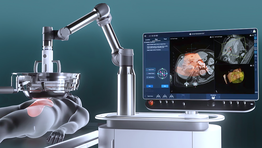 Histotripsy for liver cancer