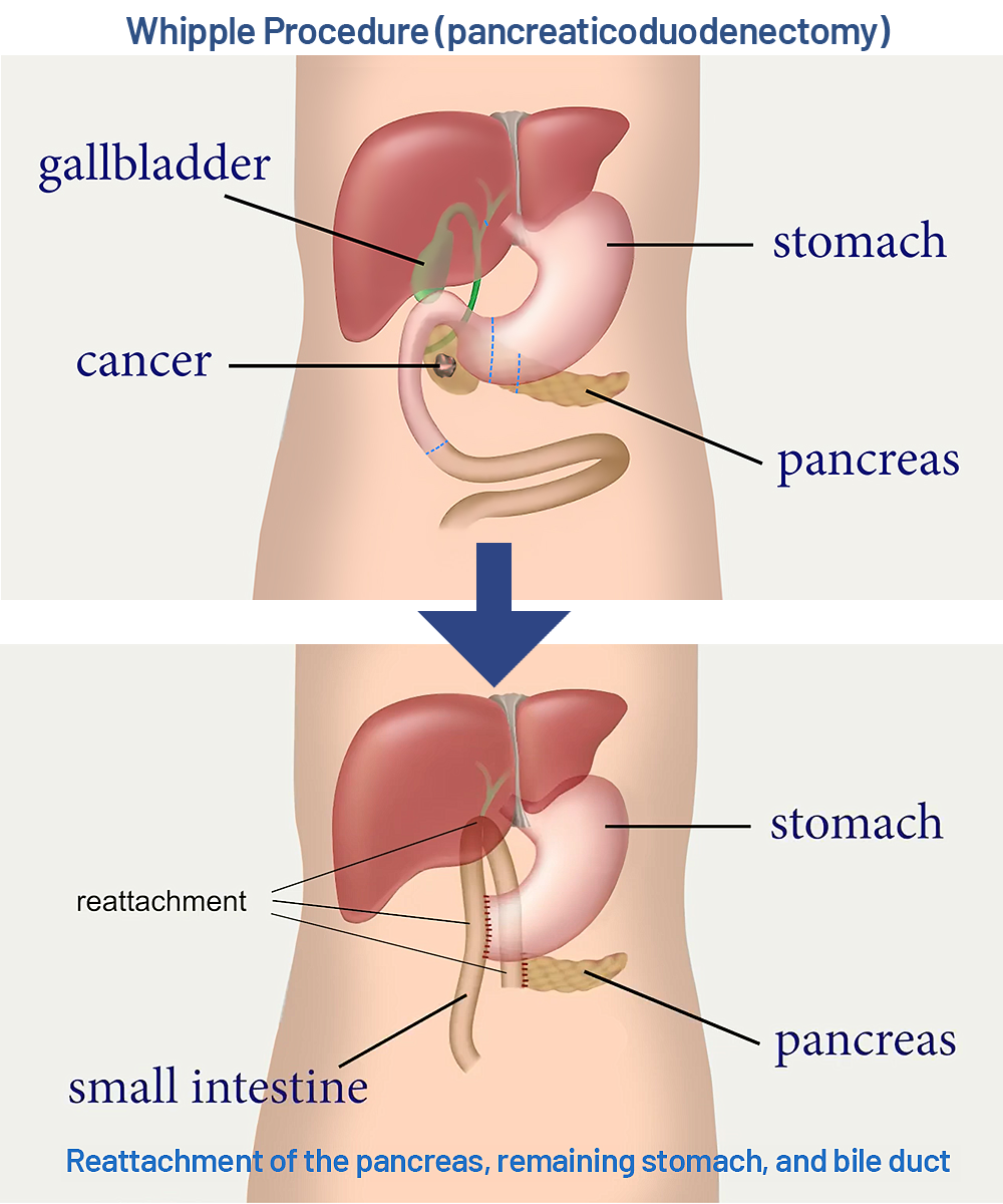 Whipple procedure diagram - before and after - Saint John's Cancer Institute