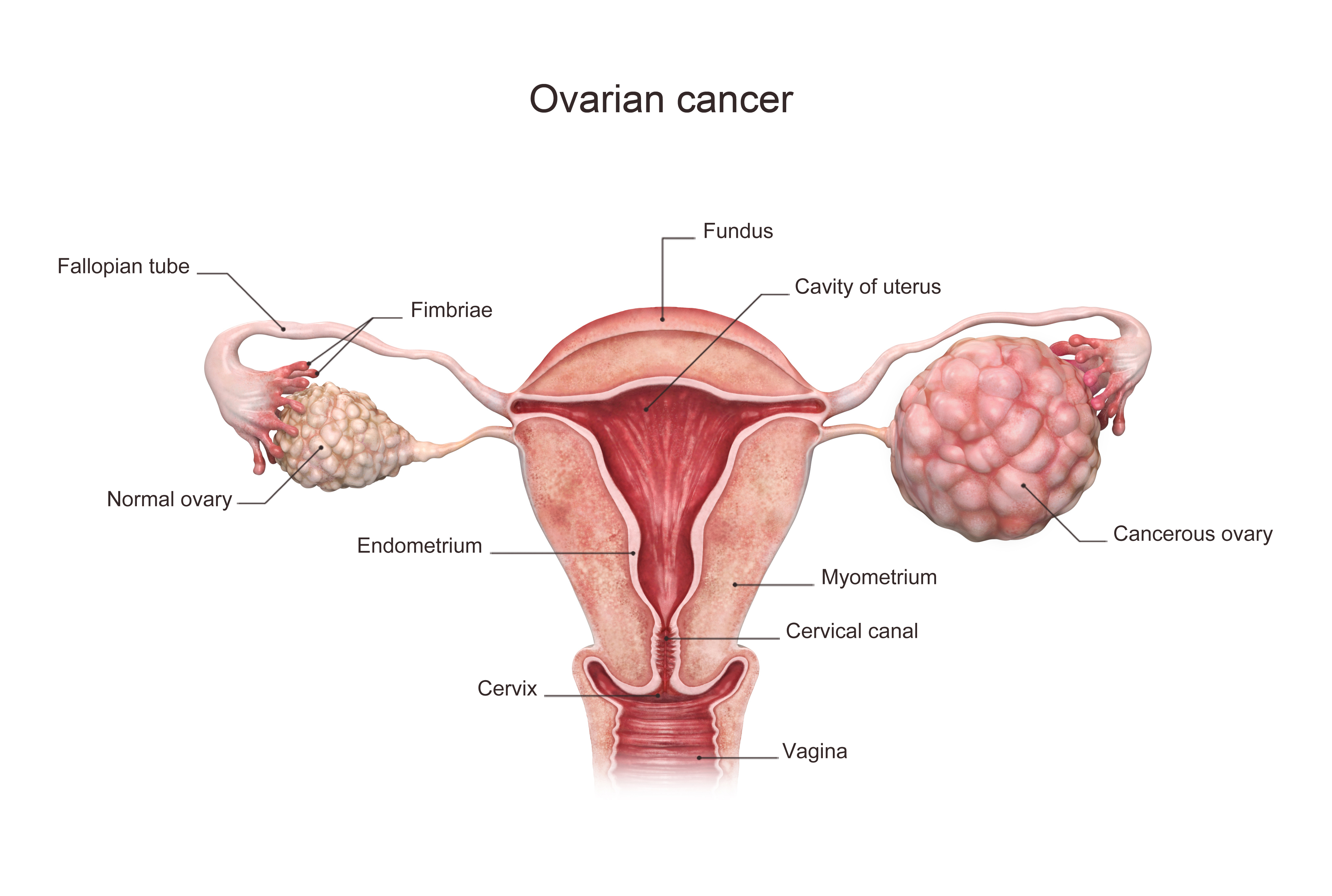 Cancerul ovarian. Simptome si factori de risc - Donna Medical Center