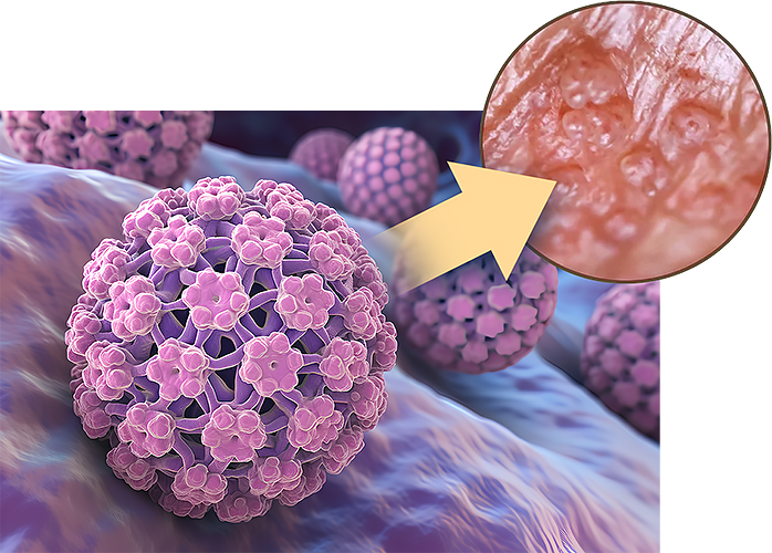 HPV-Human Papillomavirus - Saint John's Cancer Institute