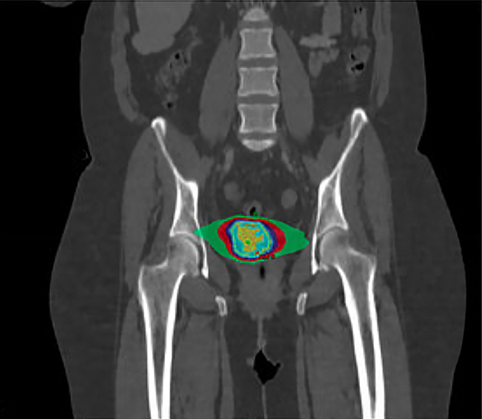 SBRT - Cervical Cancer Treatment