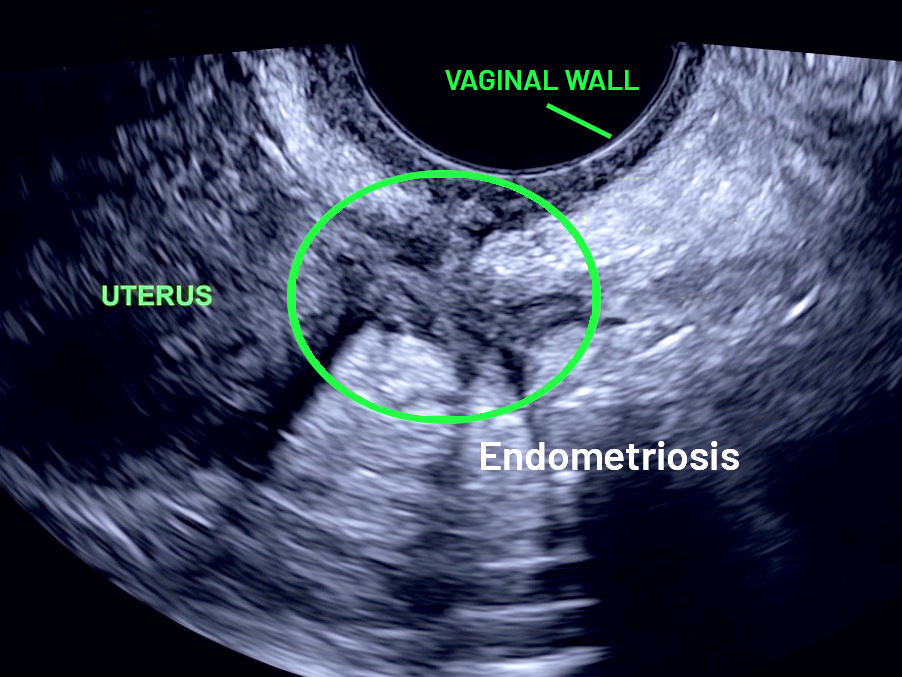 Endometriosis