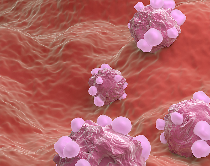 ovarian cancer 3D - microscopic