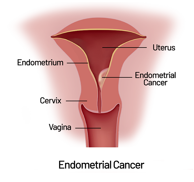 Endometrial cancer -Saint Johns Cancer Iinstitute