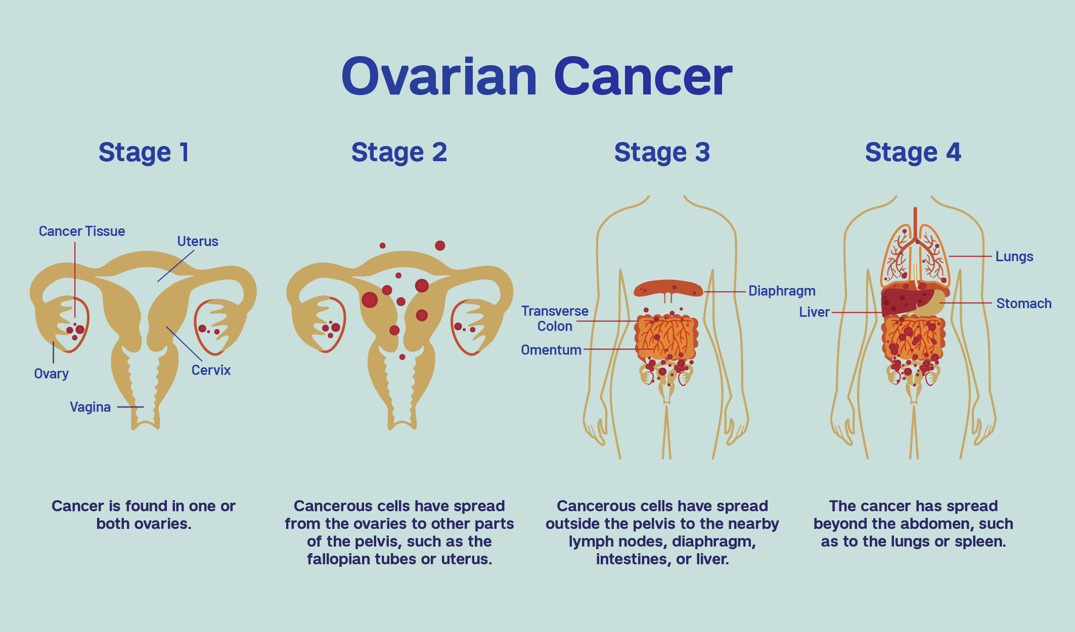 Stages of ovarian cancer