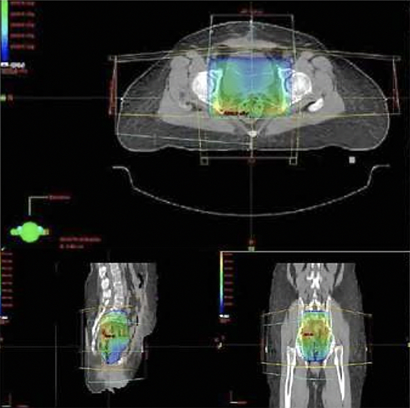 External beam treatment planning for endometrial cancers