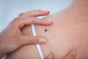 Squamous Cell Carcinoma Scc Symptoms Stages Risk Factors And Treatment Saint John S Cancer Institute