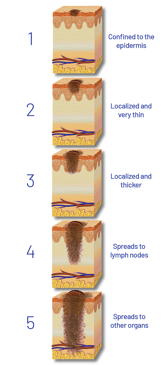 How To Identify Melanoma: Diagnosis, Stages And Expert Treatment