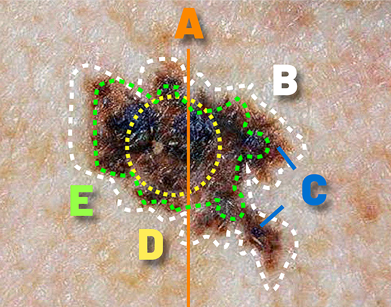 Stage 4 melanoma discount