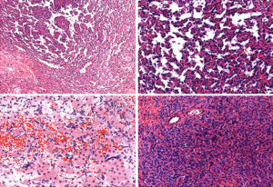 Soft Tissue Sarcoma Symptoms, Risk Factors, and Diagnosis | Saint John ...