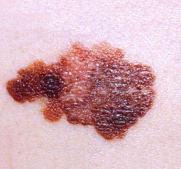 Melanoma Cancer Stages Prognosis And Expert Treatment