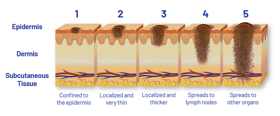 Stages of Melanoma - Saint John's Cancer Institute