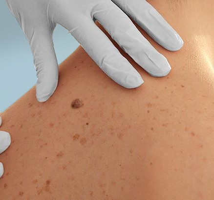 basal cell carcinoma - consultation