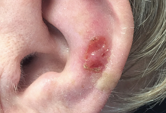 squamous cell carcinoma - who is most at risk