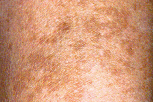 Sun overexposure - Who is most at risk?