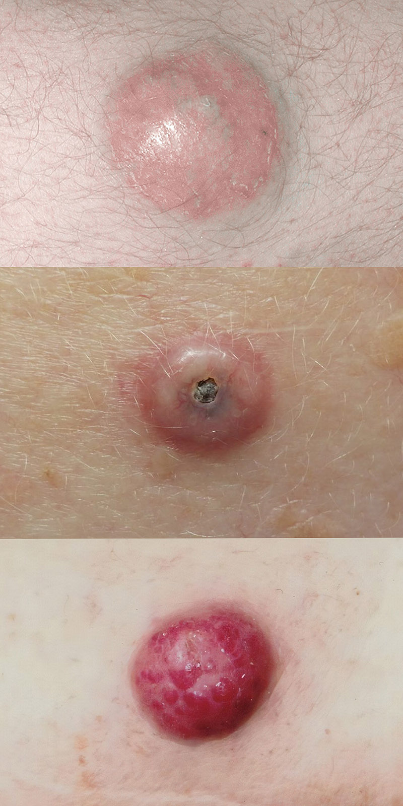 Merkel Cell Carcinoma Skin Cancer Diagnosis and Treatment Saint