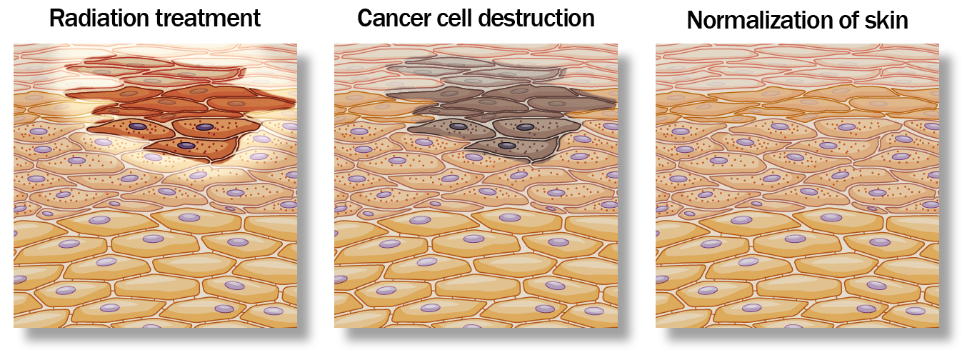 Radiation therapy disrupts cancer cell's ability to reproduce, whereas normal health y cancel can recover over time.
