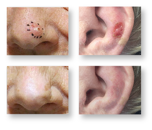 Superficial Radiotherapy Treatment - Saint John's Cancer Institute