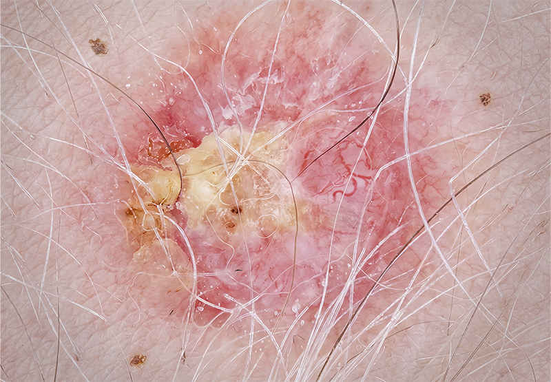 Dermascopy evaluation - Saint John's Pigmented Skin Lesion Clinic
