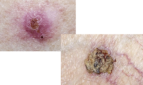 Basal cell carcinoma