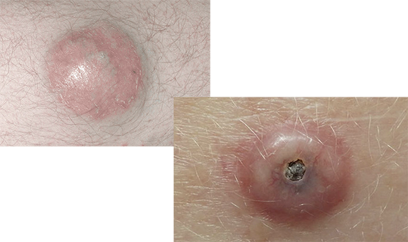 Merkel cell carcinoma  appears as flesh-colored or a deep-red nodule on surface of the skin.