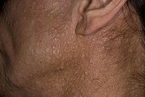 skin changes associated with Birt Hogg Dubé Syndrome