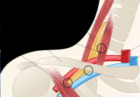 Thoracic Outlet Syndrome illustration