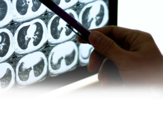 CT scan - lung screening - patient education