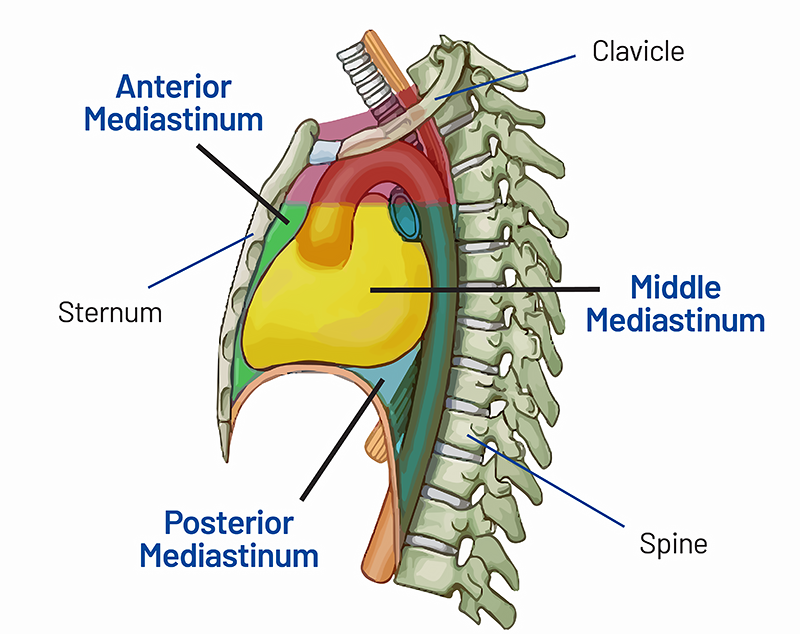 Mediastinal Mass (Tumor): Types, Symptoms, Causes & Treatment