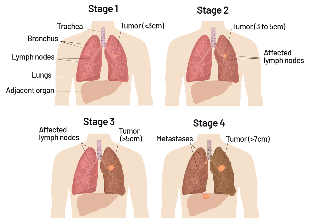 Lung Cancer Symptoms, Risk Factors, Diagnosis, and Treatment