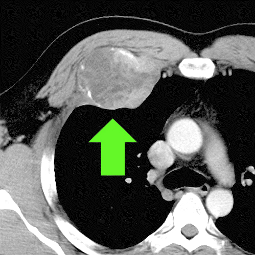 chest wall tumor - CT scan diagnosis