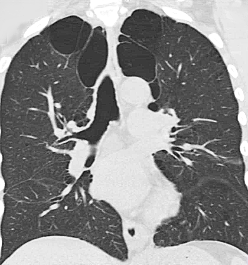 Emphysema is visible on ct scan