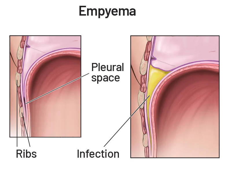 empyma