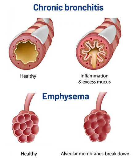 COPD - Saint John's Health Center