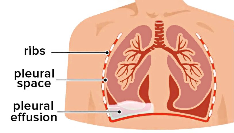 Pleural effusion