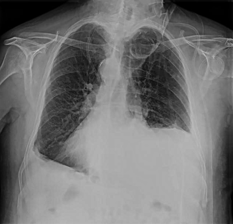 Diaphragm Paralysis