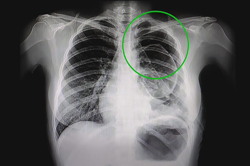 COPD-related Collapsed lung
