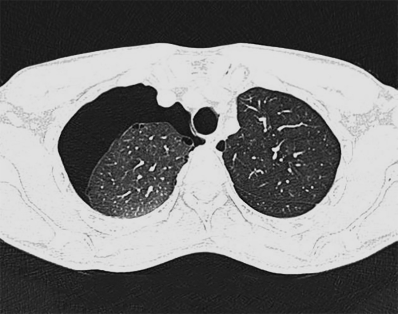 CT scan - discovery of blebs and bullae