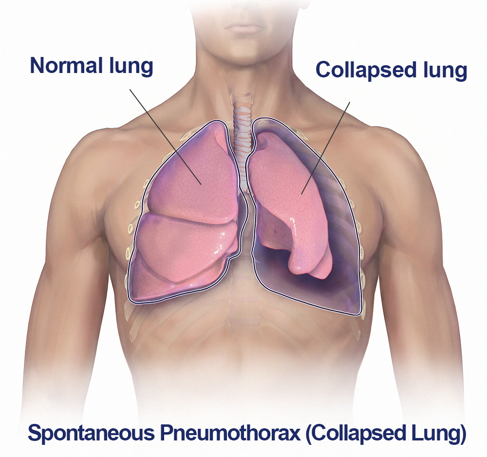 Spontaneous Pneumothorax (Collapsed Lung) - Saint John's Health Center