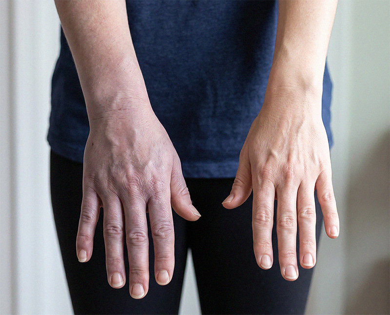 Symtoms of venous thoracic outlet syndrome - Saint John's Health Center
